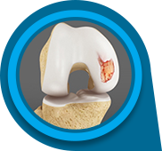 Articular Cartilage Injury