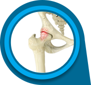 Femoroacetabular Impingement