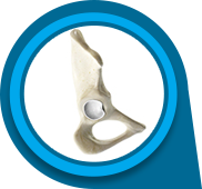 Hip Labral Tear