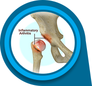 Inflammatory Arthritis of the Hip