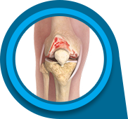 Knee Osteoarthritis