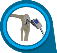 Knee Replacement with OrthAlign Technology