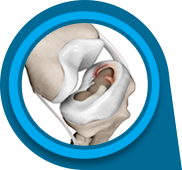 Meniscal Injuries