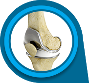 Outpatient Total Knee Replacement