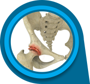 Osteoarthritis of the Hip