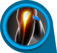 Outpatient Anterior Approach Hip Replacement