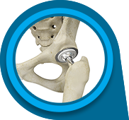 Outpatient Hip Replacement