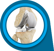 Unicompartmental/Partial Knee Replacement