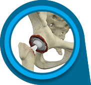 Revision Hip Replacement