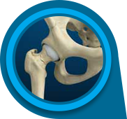 Stress Fractures of the Hip