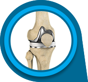 Total Knee Replacement